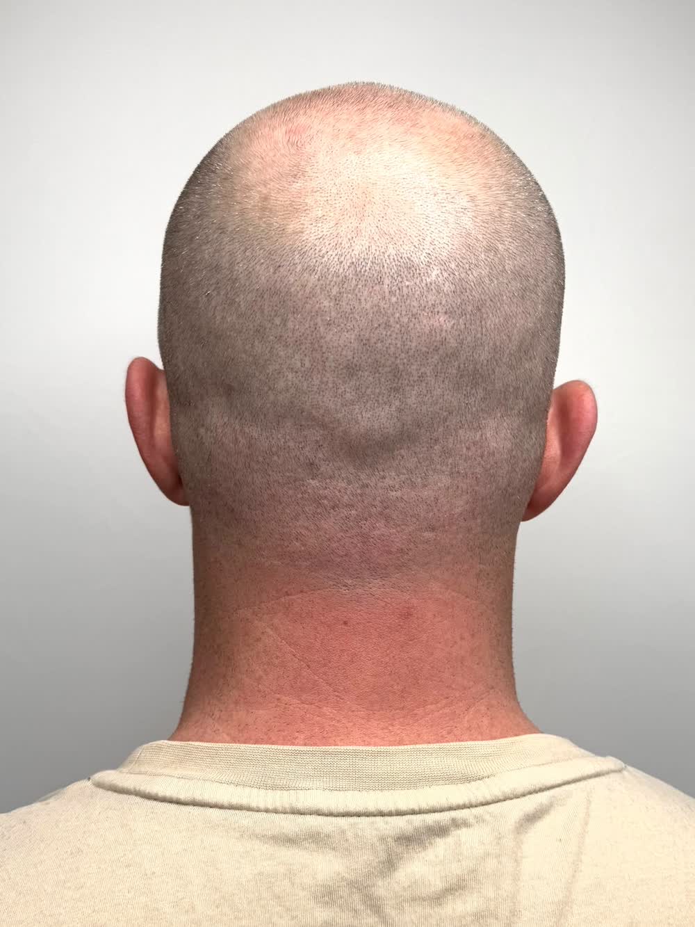 Dieselbe Kopfhaut nach der Haarpigmentierung, gleichmaessig dicht