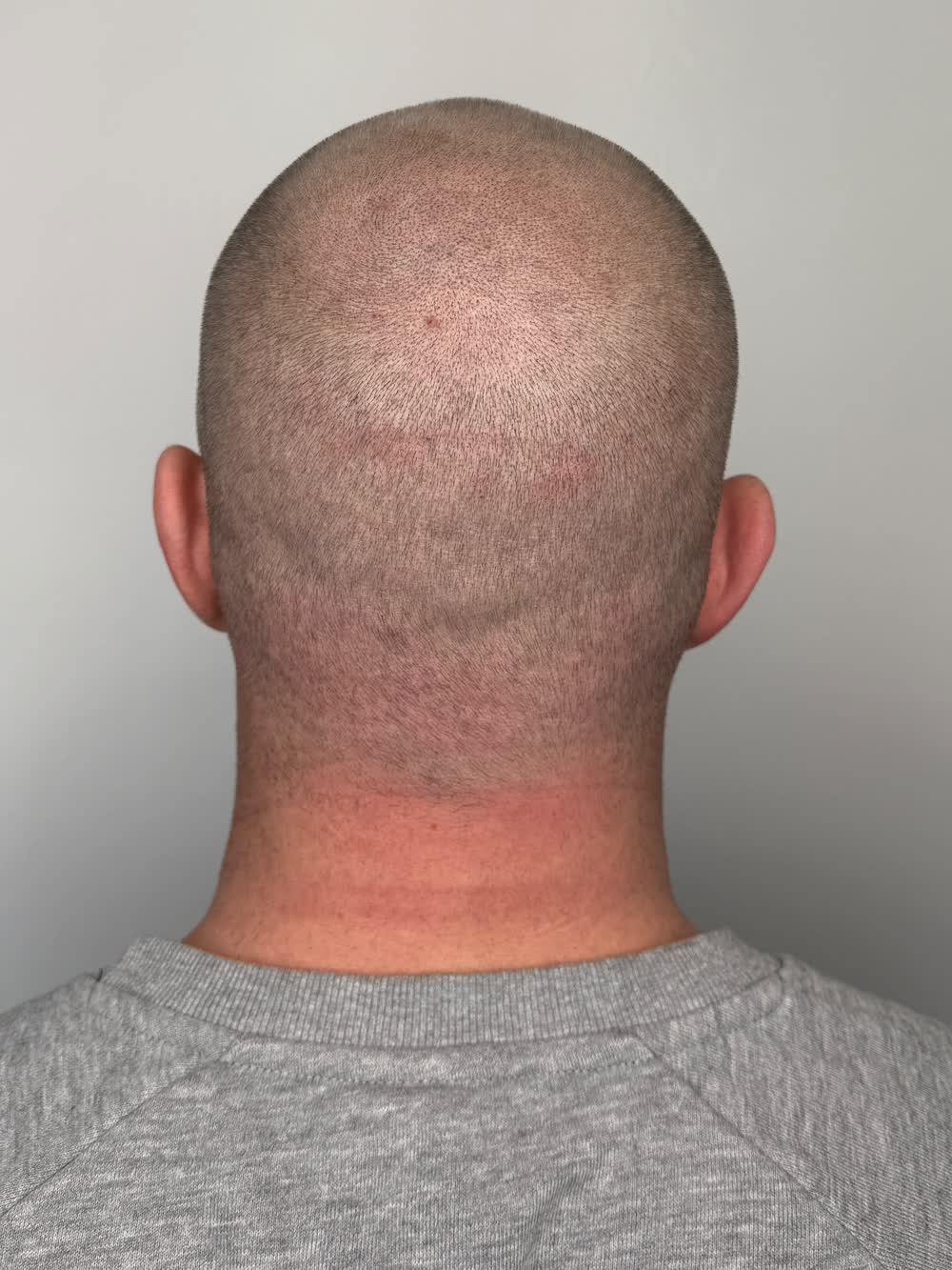 Kopfhaut von hinten vor der Haarpigmentierung, der Oberkopf ist kahl
