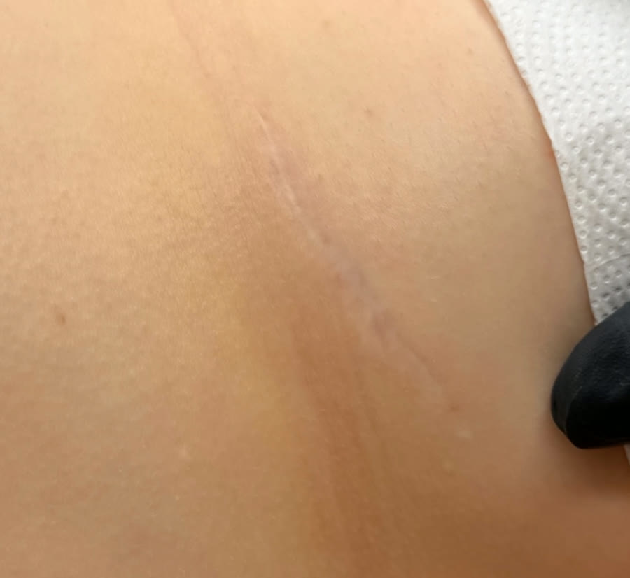 Dichterer Haaransatz nach der Haarbodenverdichtung