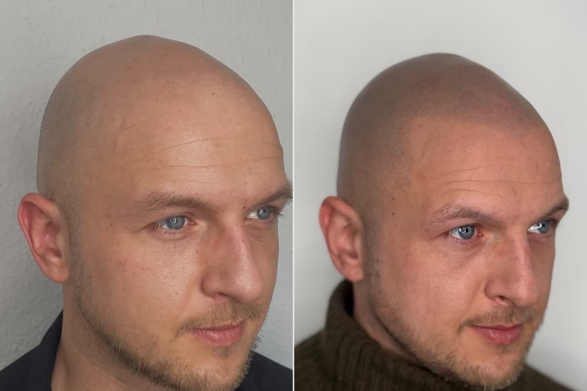 Kopfhaut nach Haarpigmentierung im Shaved Look